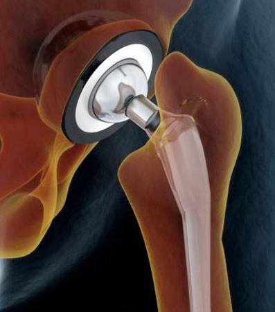 Hip Replacement Surgery Diagram