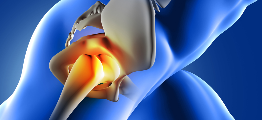 Total Hip Replacement